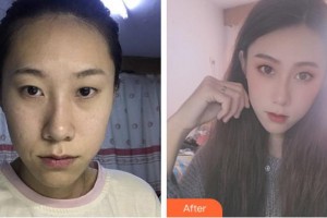 成都愛迪眼科醫(yī)院劉鵬飛整形價格表附眼部整形案例展示