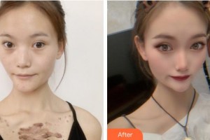 成都市新都區(qū)人民醫(yī)院眼科蔣娛整形價格表附雙眼皮內眼角案例展示