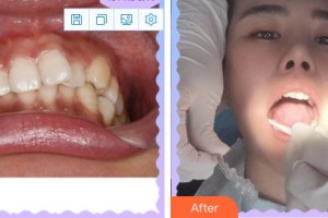 成都佰視達眼科門診部林文整形價格表附牙綜合案例展示