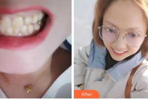 成都華西牙種植醫(yī)院吳大怡整形價(jià)格表附牙齒陶瓷貼面案例展示