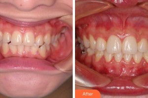 成都純福口腔診所劉明曦整形價(jià)格表附牙齒正畸案例展示