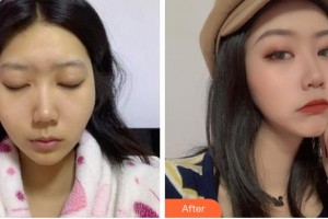 成都天姿醫(yī)療美容門診部李雯雯整形價(jià)格表附顴骨內(nèi)推案例展示