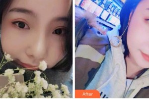 成都潔西口腔診所董凱整形價(jià)格表附牙齒矯正案例展示