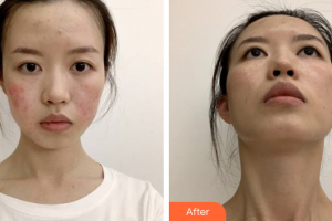 廣州康華清醫(yī)學(xué)美容門診部王群整形價格表附點陣激光祛痘案例展示