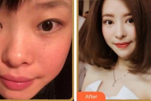 成都中醫(yī)大銀海眼科醫(yī)院黃霄整形價格表附眼部整形案例展示