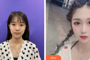 廣州康華清醫(yī)學(xué)美容門診部萬佩整形價格表附光子嫩膚案例展示