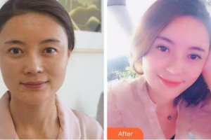 成都中醫(yī)大銀海眼科醫(yī)院王國平整形價格表附眼部整形案例展示