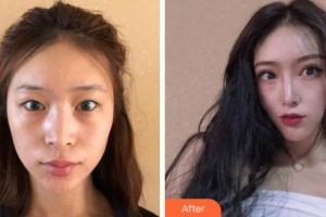 成都中醫(yī)大銀海眼科醫(yī)院袁曉輝整形價格表附雙眼皮案例展示