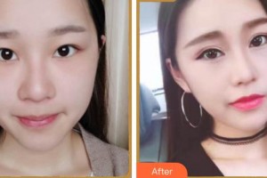 成都中醫(yī)大銀海眼科醫(yī)院霍劍整形價格表附眼部多項案例展示