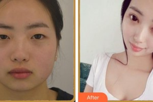 成都中醫(yī)大銀海眼科醫(yī)院蹇文淵整形價格表附眼部綜合案例展示