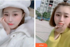 成都中醫(yī)大銀海眼科醫(yī)院張文炳整形價格表附開外眼角案例展示