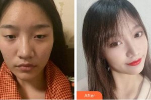 成都中醫(yī)大銀海眼科醫(yī)院李蓓整形價格表附眼部整形案例展示