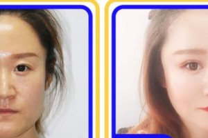 成都中醫(yī)大銀海眼科醫(yī)院陳小鳳整形價格表附眼部綜合案例展示