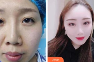 成都中醫(yī)大銀海眼科醫(yī)院尹朔住院醫(yī)師整形價格表附眼部修復(fù)案例展示