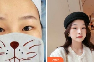 成都中醫(yī)大銀海眼科醫(yī)院蒙軒住院醫(yī)師整形價格表附眼部手術(shù)案例展示