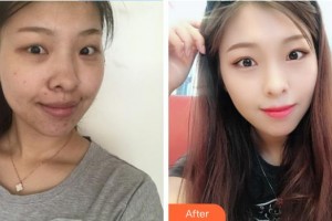 成都新視界眼科醫(yī)院賈春月整形價格表附眼部手術(shù)案例展示