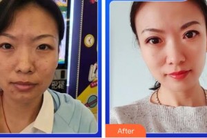 成都新視界眼科醫(yī)院余小清整形價格表附5s重瞼術(shù)+超微創(chuàng)開內(nèi)眥案例展示