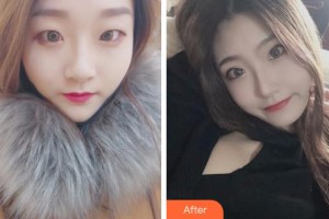 成都新視界眼科醫(yī)院許海嘉整形價格表附眼部整形案例展示