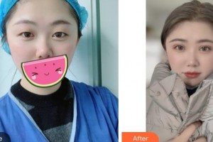 成都新視界眼科醫(yī)院賈立整形價格表附眼部整形案例展示