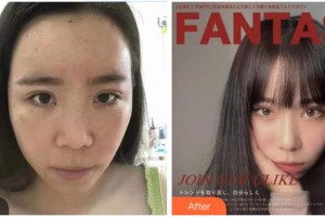 成都新視界眼科醫(yī)院屈雪梅整形價格表附切開重瞼+內(nèi)眥贅皮矯正案例展示