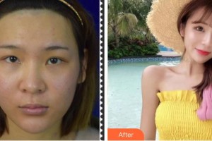 成都新視界眼科醫(yī)院蔡立歡整形價格表附眼部綜合案例展示