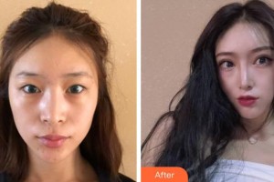 成都美壹典醫(yī)療美容診所魏鵬整形價格表附切開雙眼皮案例展示