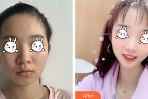 廣州從化現(xiàn)代醫(yī)院廖安整形價格表附光子嫩膚案例展示