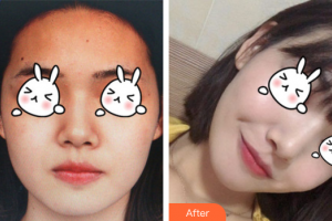 廣州從化現(xiàn)代醫(yī)院劉攸香整形價格表附無針?biāo)獍咐故?>
</a>
<h3 class=