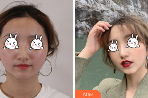 廣州尚美善造美容醫(yī)院張經(jīng)祥整形價格表附光子嫩膚案例展示