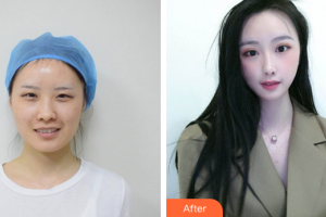 廣州天姿醫(yī)學(xué)美容門診部侯文明整形價格表附眼部整形案例展示