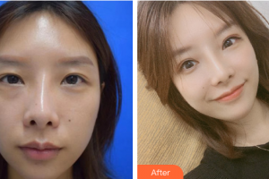 廣州尚美善造美容醫(yī)院葉蓓慧整形價格表附雙眼皮修復(fù)案例展示