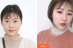 福建醫(yī)科大學(xué)附屬協(xié)和醫(yī)院整形激光美容中心江成鴻整形價(jià)格表附膨體隆鼻案例展示