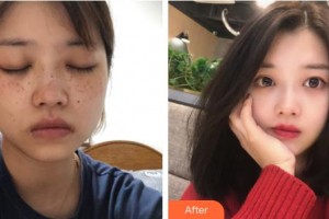 福建醫(yī)科大學(xué)附屬協(xié)和醫(yī)院整形激光美容中心周亞寬整形價(jià)格表附激光美膚案例展示