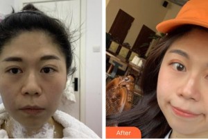 福建武警總隊(duì)醫(yī)院激光美容中心鄭清建整形價(jià)格表附熱瑪吉抗衰案例展示