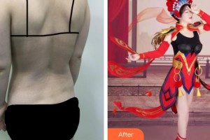 福建省人民醫(yī)院整形中心鐘盛全整形價(jià)格表附全身吸脂案例展示