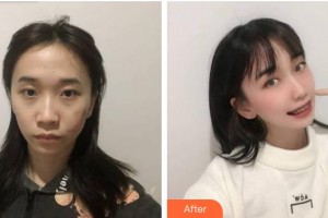 福建醫(yī)科大學(xué)附屬第二醫(yī)院眼科中心王鳳整形價(jià)格表附眼部整形案例展示