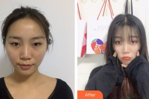 福建醫(yī)科大學(xué)附屬第二醫(yī)院眼科中心高瑩瑩整形價(jià)格表附眼部整形案例展示