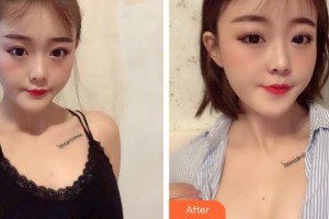 福州臺(tái)江醫(yī)院整形美容中心包德瑞整形價(jià)格表附濃縮豐胸真實(shí)案例展示