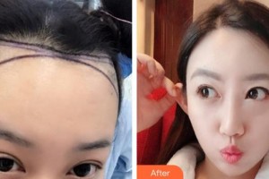 福州中意醫(yī)療美容門診部黃鎮(zhèn)熙整形價(jià)格表附發(fā)際線種植案例展示