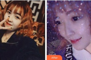 福州市鼓樓醫(yī)院整形美容中心周曼麗整形價(jià)格表附超聲波洗牙案例展示