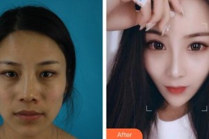 福州海峽美容醫(yī)院王英勇整形價(jià)格表附鼻部手術(shù)案例展示