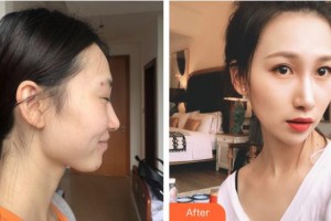 福州愛(ài)美爾整形美容醫(yī)院范德厚整形價(jià)格表附下頜角顴骨顴弓外板案例展示