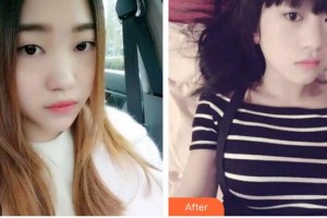 福州海峽美容醫(yī)院賀寶陣整形價(jià)格表附牙齒金屬矯正案例展示