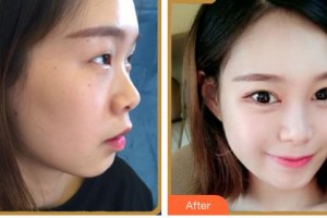 福州美萊華美美容醫(yī)院何宜新整形價(jià)格表附下頜角整形案例展示