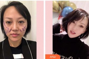 福州愛(ài)美爾整形美容醫(yī)院邱富美整形價(jià)格表附抗初老熱瑪吉案例展示