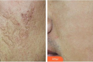 福州愛思特比華利整形美容醫(yī)院林秋蓉整形價格表附凹陷疤痕案例展示