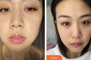 福州美貝爾醫(yī)療美容門診部姚文華整形價格表附超激光美膚祛斑案例展示