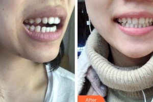 福州愛思特比華利整形美容醫(yī)院強副主任 主診醫(yī)師整形價格表附牙齒矯正案例展示