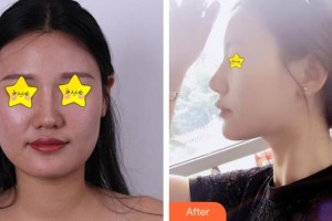 福州優(yōu)美醫(yī)療美容診所袁宇綱整形價格表附假體隆下頜案例展示