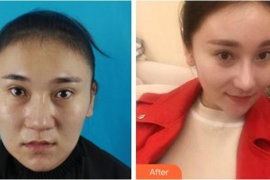 福州名韓整形美容醫(yī)院溫名赟整形價格表附鼻部整形案例展示